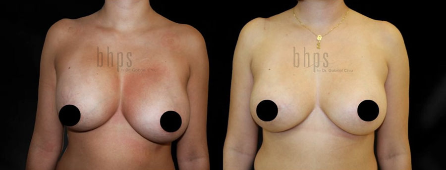 Cosmetic Breast Reconstruction Patient 05 Before & After