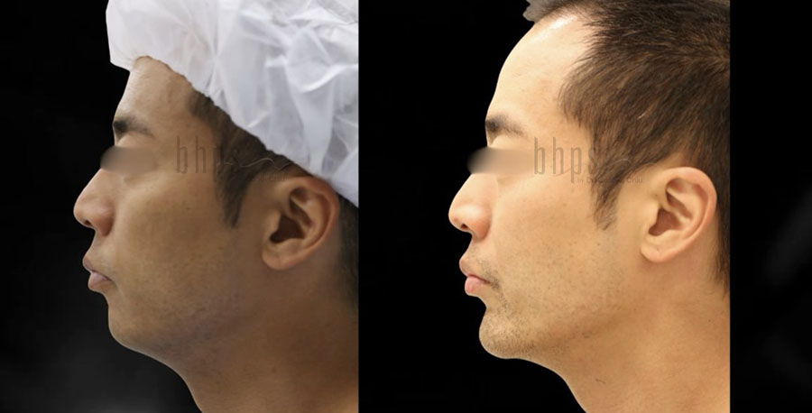 Chin Augmentation Patient 04 Before & After