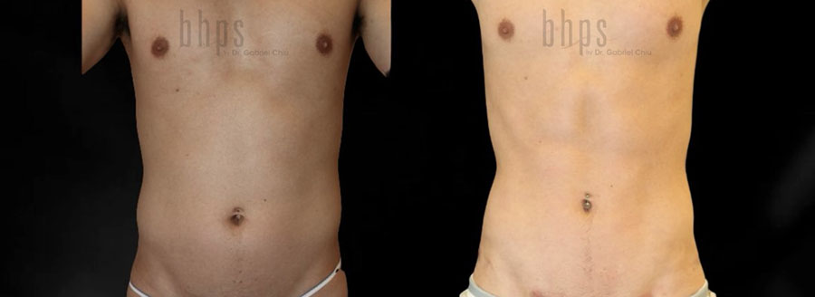 Abdominal Etching/Male Liposuction Patient 10 Before & After