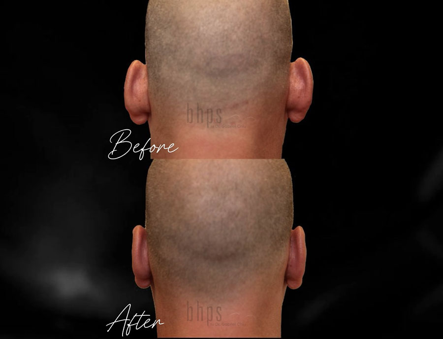 Otoplasty Patient 09 Before & After