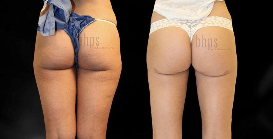 Liposuction Patient 60 Before & After