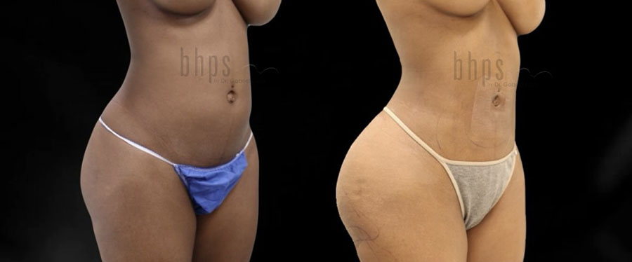 Brazilian Butt Lift Patient 39 Before & After