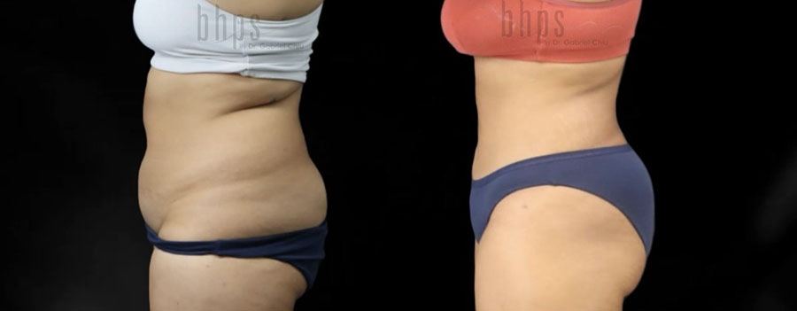 Liposuction Patient 61 Before & After