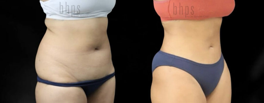 Liposuction Patient 61 Before & After