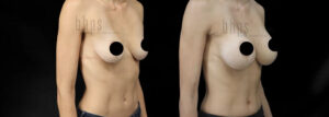 Breast Augmentation Patient 109 Before & After - Thumbnail