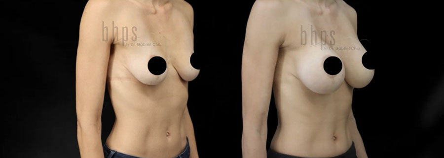 Breast Augmentation Patient 109 Before & After