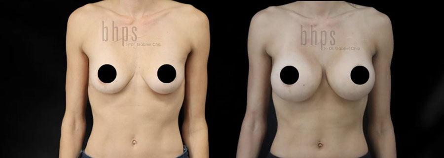 Breast Augmentation Patient 109 Before & After