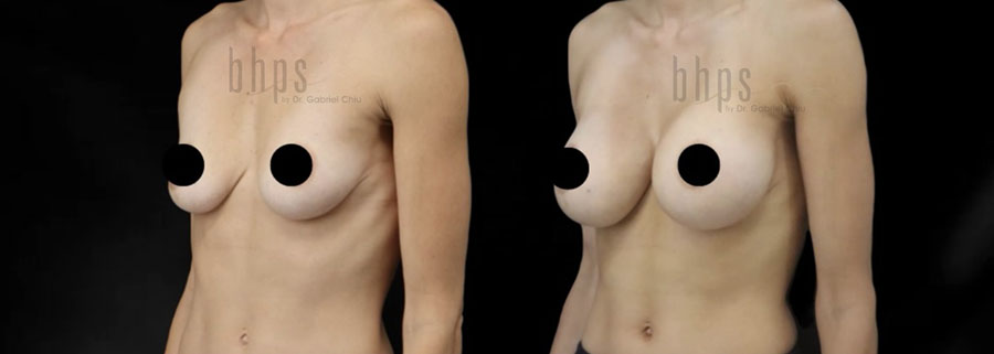 Breast Augmentation Patient 109 Before & After