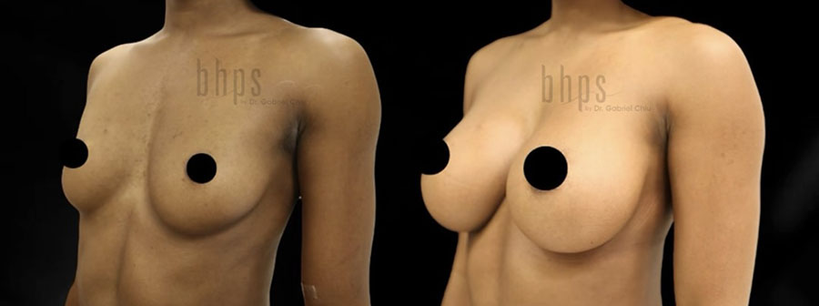 Breast Augmentation Patient 108 Before & After