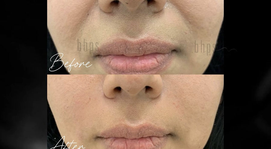 Non-Surgical Patient 03 Before & After