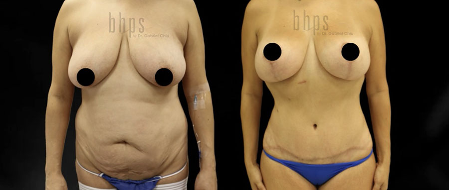 Tummy Tuck Patient 34 Before & After