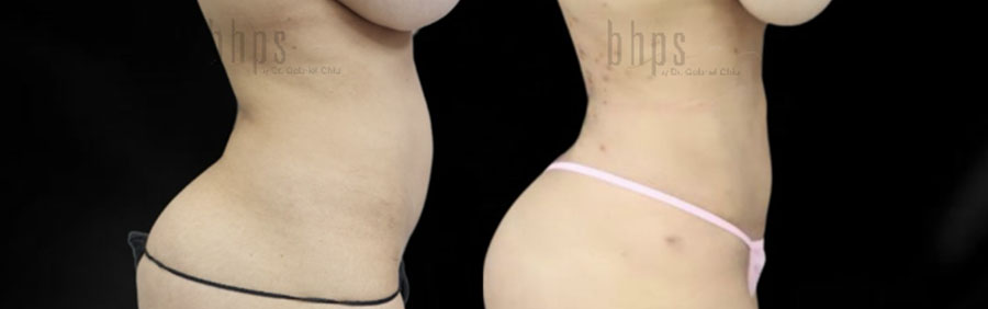 Liposuction Patient 62 Before & After