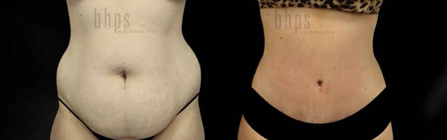 Tummy Tuck Patient 35 Before & After