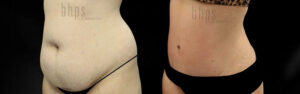 Tummy Tuck Patient 35 Before & After - Thumbnail