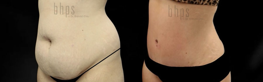 Tummy Tuck Patient 35 Before & After