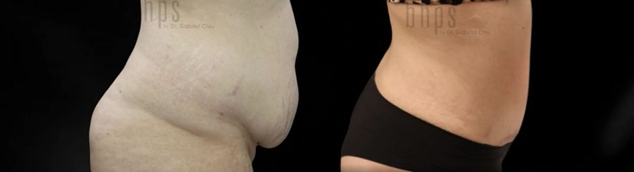 Tummy Tuck Patient 35 Before & After