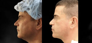 Liposuction Patient 64 Before & After - Thumbnail