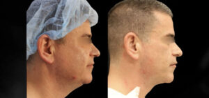 Liposuction Patient 64 Before & After - Thumbnail