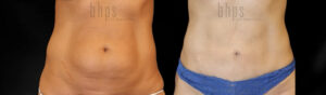 Tummy Tuck Patient 36 Before & After - Thumbnail