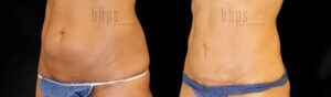 Tummy Tuck Patient 36 Before & After - Thumbnail