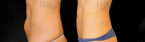 Tummy Tuck Patient 36 Before & After - Thumbnail