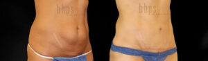 Tummy Tuck Patient 36 Before & After - Thumbnail