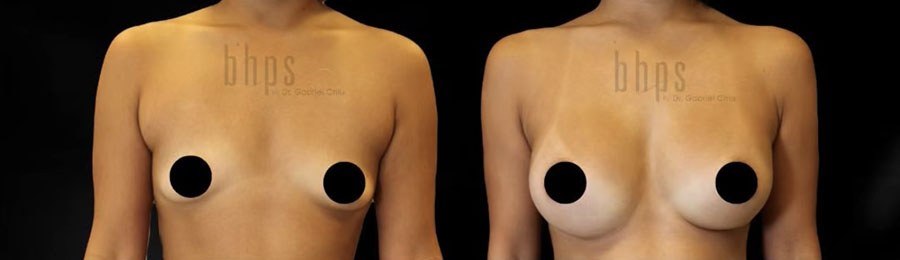 Breast Augmentation Patient 110 Before & After