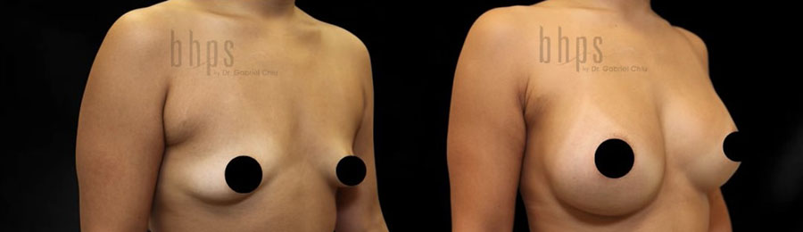 Breast Augmentation Patient 110 Before & After