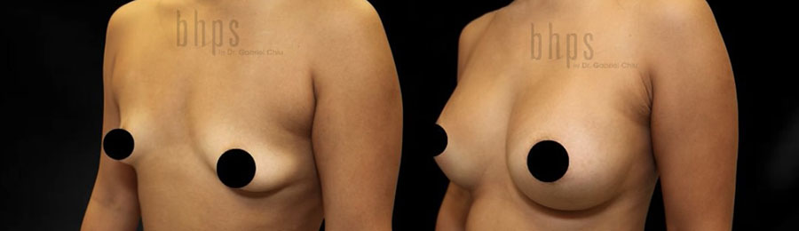 Breast Augmentation Patient 110 Before & After