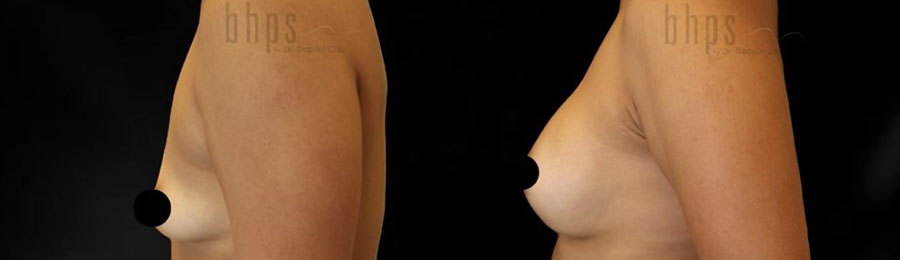 Breast Augmentation Patient 110 Before & After