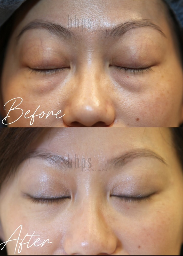 Blepharoplasty Patients 08 Before & After