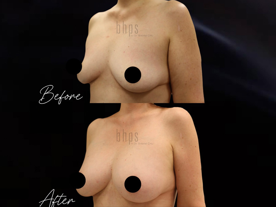 Fat Transfer Patient 05 Before & After