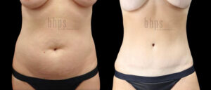 Tummy Tuck Patient 29 Before & After - Thumbnail