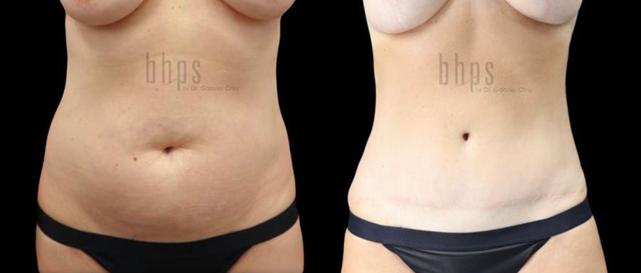 Tummy Tuck Patient 29 Before & After