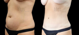 Tummy Tuck Patient 29 Before & After - Thumbnail