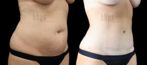 Tummy Tuck Patient 29 Before & After - Thumbnail