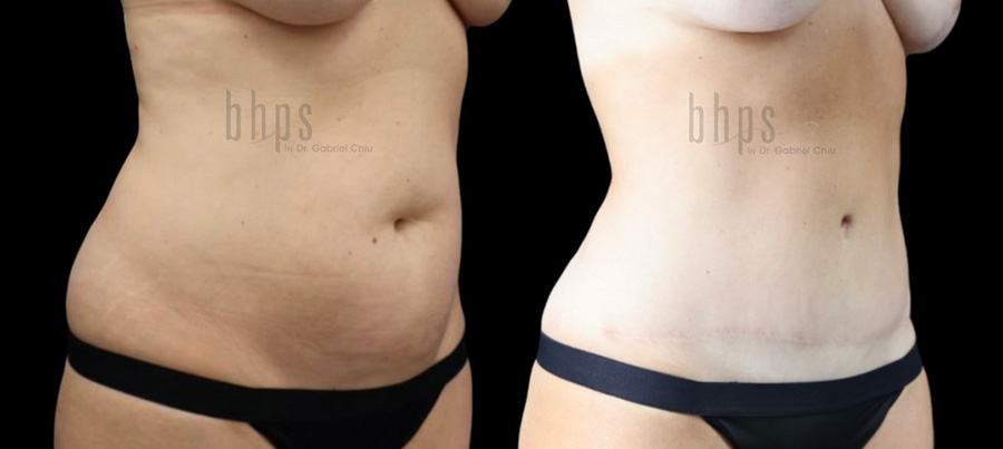 Tummy Tuck Patient 29 Before & After