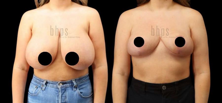 Breast Reduction Patient 02 Before & After