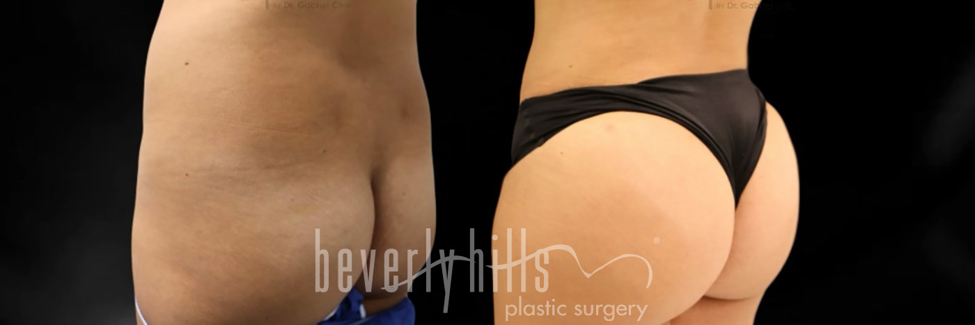 Brazilian Butt Lift Patient 36 Before & After