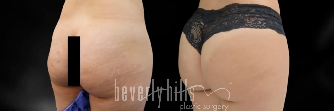 Brazilian Butt Lift Patient 35 Before & After