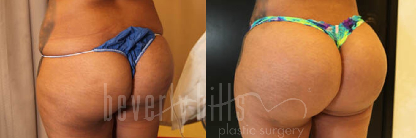 Brazilian Butt Lift Before and After Beverly Hills - Millicent