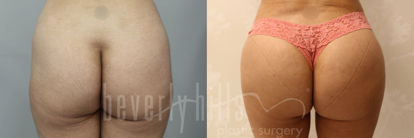 Beverly Hills Plastic Surgery Butt Augmentation Before & After Photos