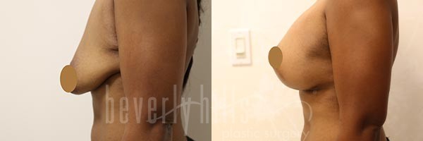 Boob Pop - Before and After Gallery