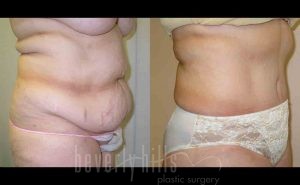 Tummy Tuck Patient 14 Before & After - Thumbnail