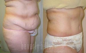 Tummy Tuck Patient 14 Before & After - Thumbnail