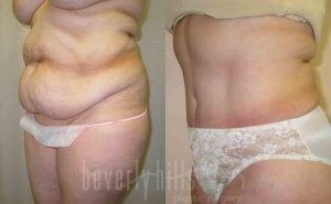 Tummy Tuck Patient 14 Before & After - Thumbnail