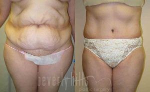 Tummy Tuck Patient 14 Before & After - Thumbnail