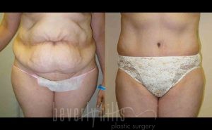 Tummy Tuck Patient 14 Before & After - Thumbnail