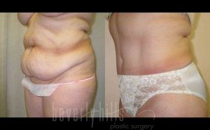 Tummy Tuck Patient 14 Before & After - Thumbnail