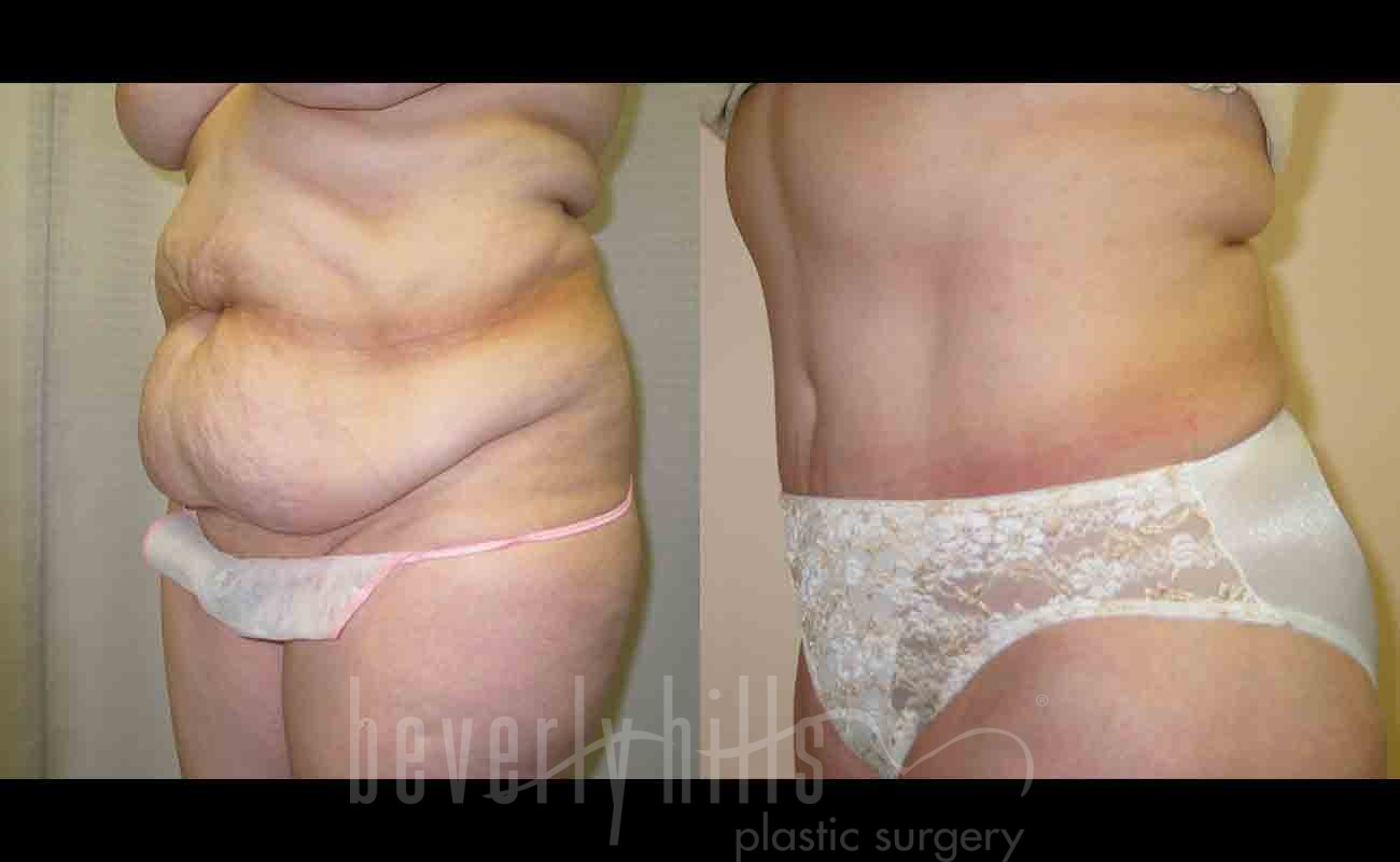 Tummy Tuck Patient 14 Before & After